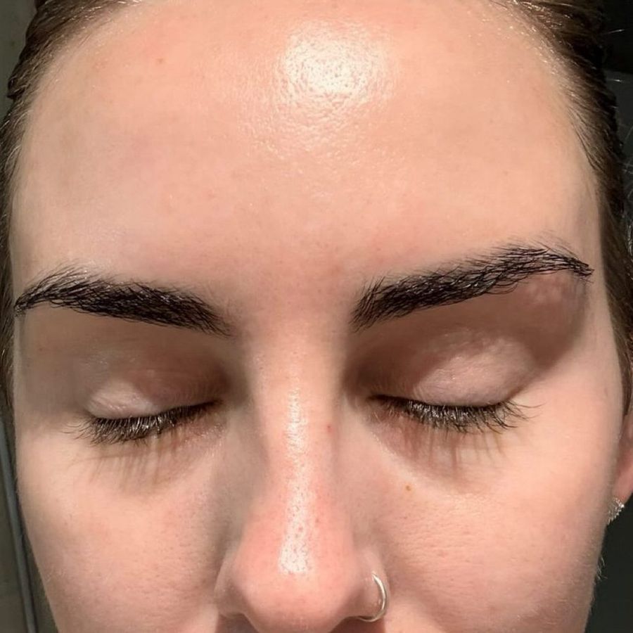 Anti-wrinkle & polynucleotides at The Face Lab, after treatment by Becci