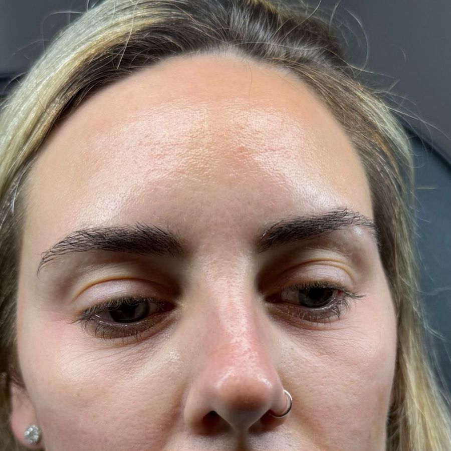 Anti-wrinkle & polynucleotides at The Face Lab, before treatment