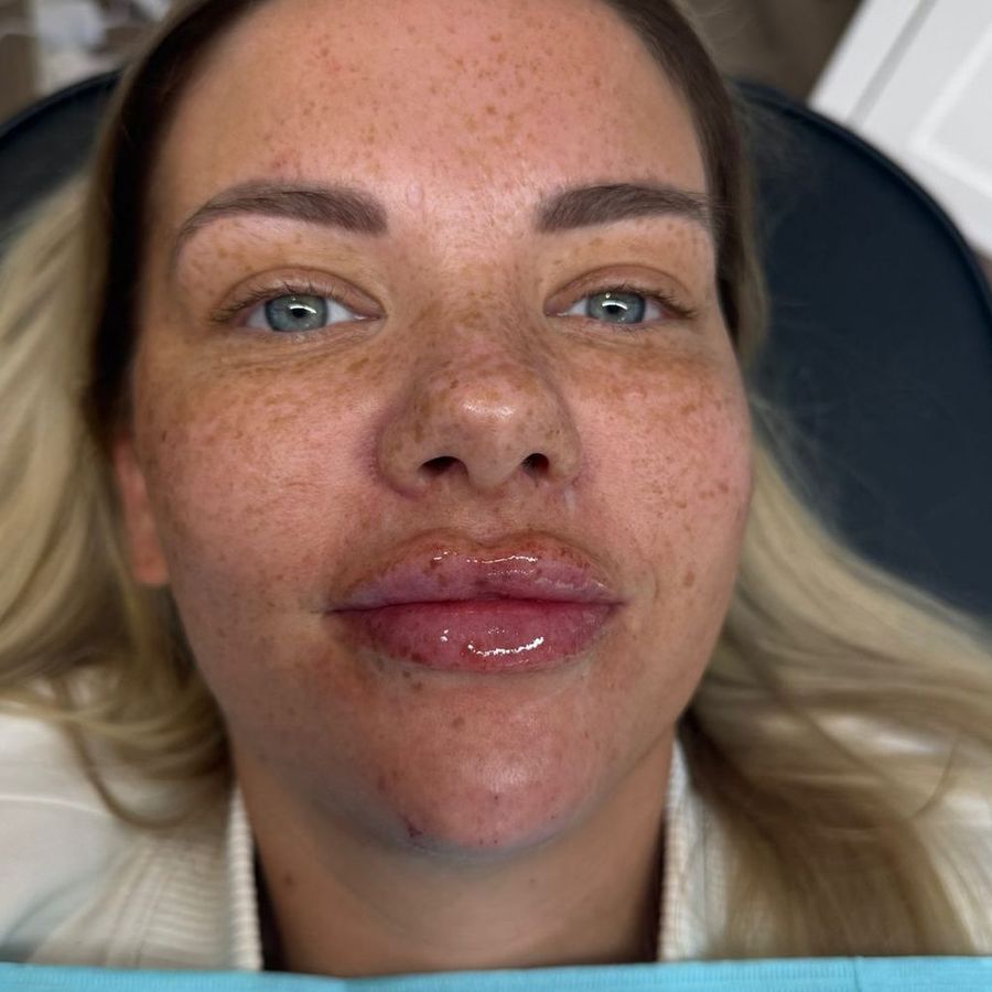 Lip & chin filler at The Face Lab, after treatment by Becci