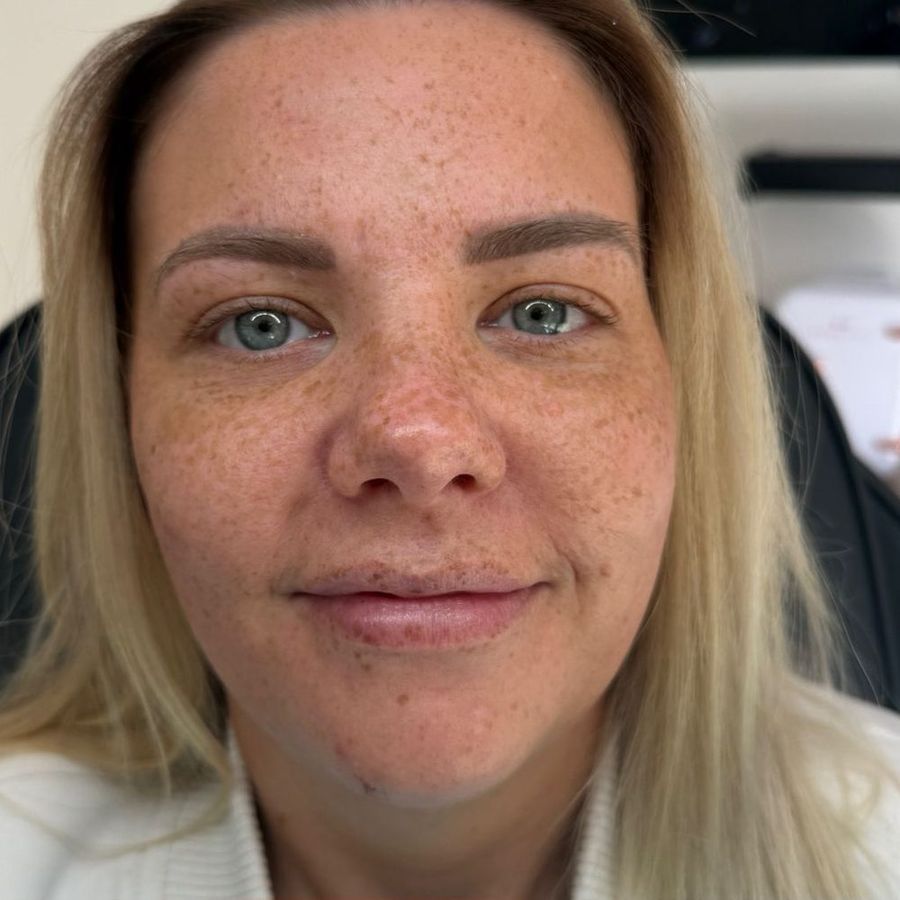 Lip & chin filler at The Face Lab, before treatment