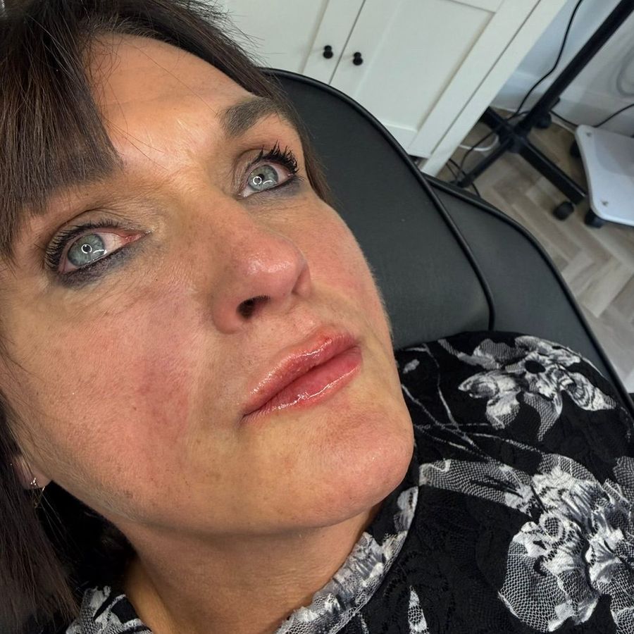 Lip filler at The Face Lab, after treatment by Becci