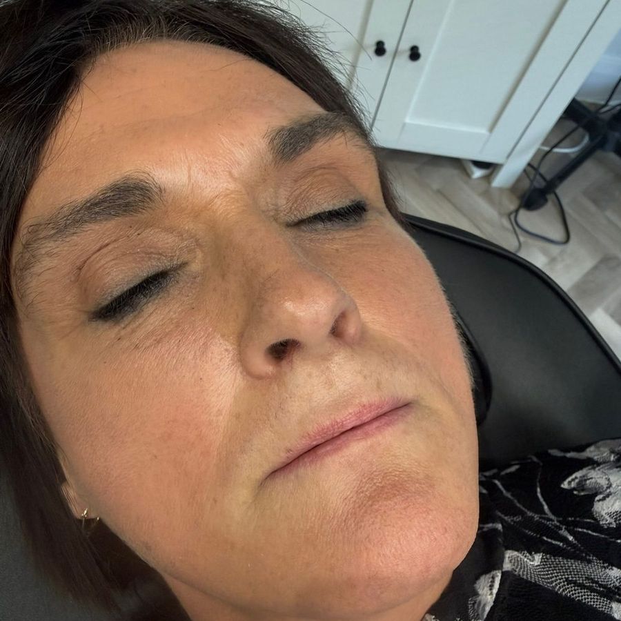 Lip filler at The Face Lab, before treatment