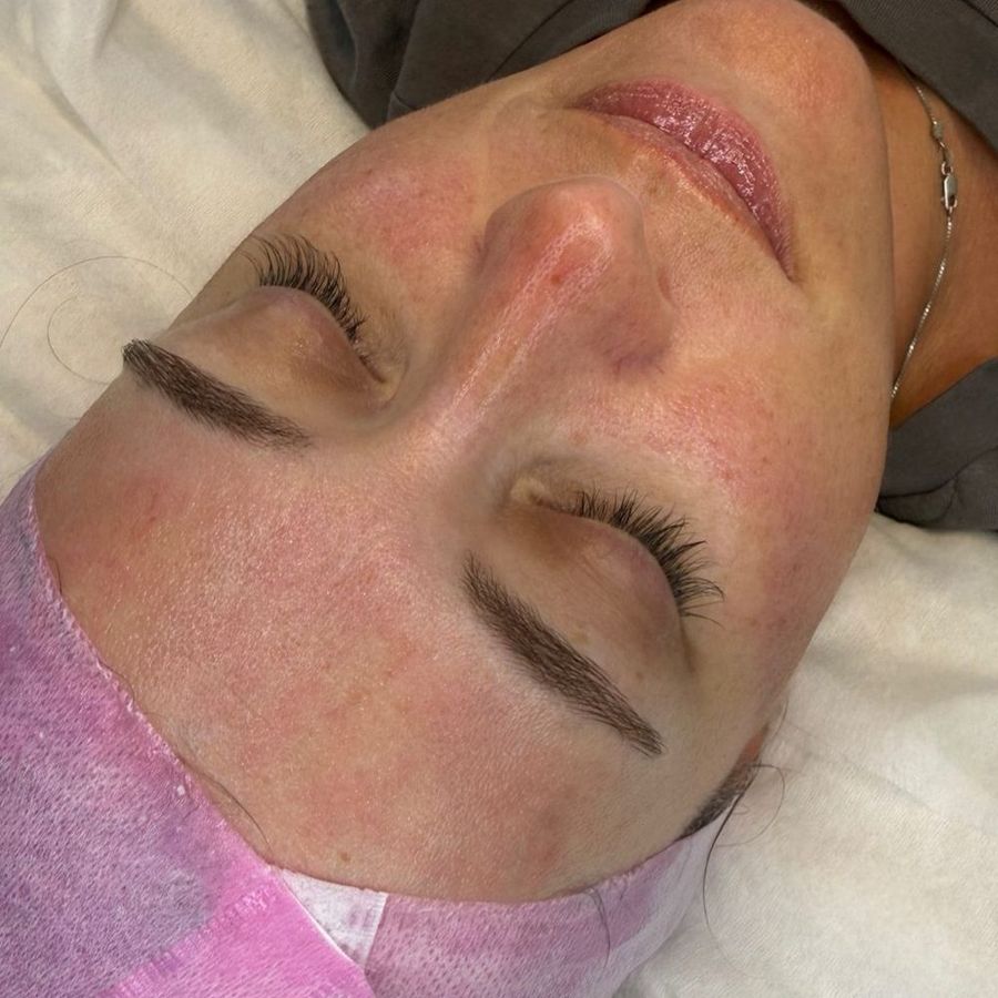 Microneedling at The Face Lab, after treatment by Becci