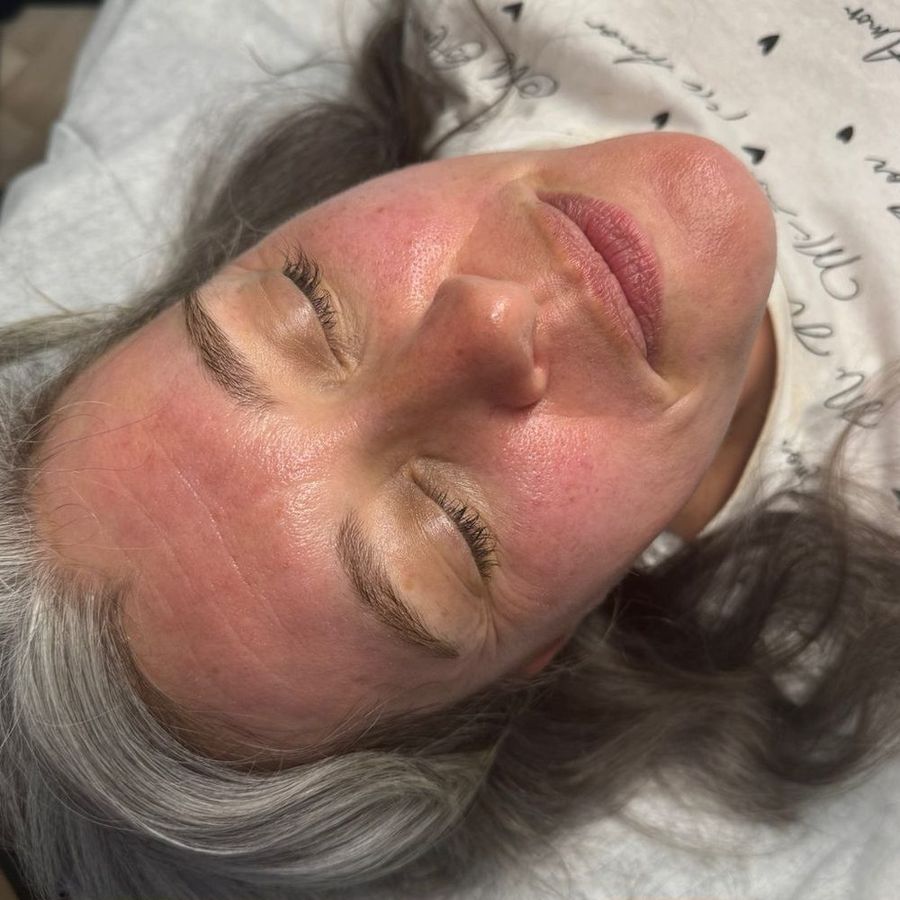 Microneedling at The Face Lab, before treatment
