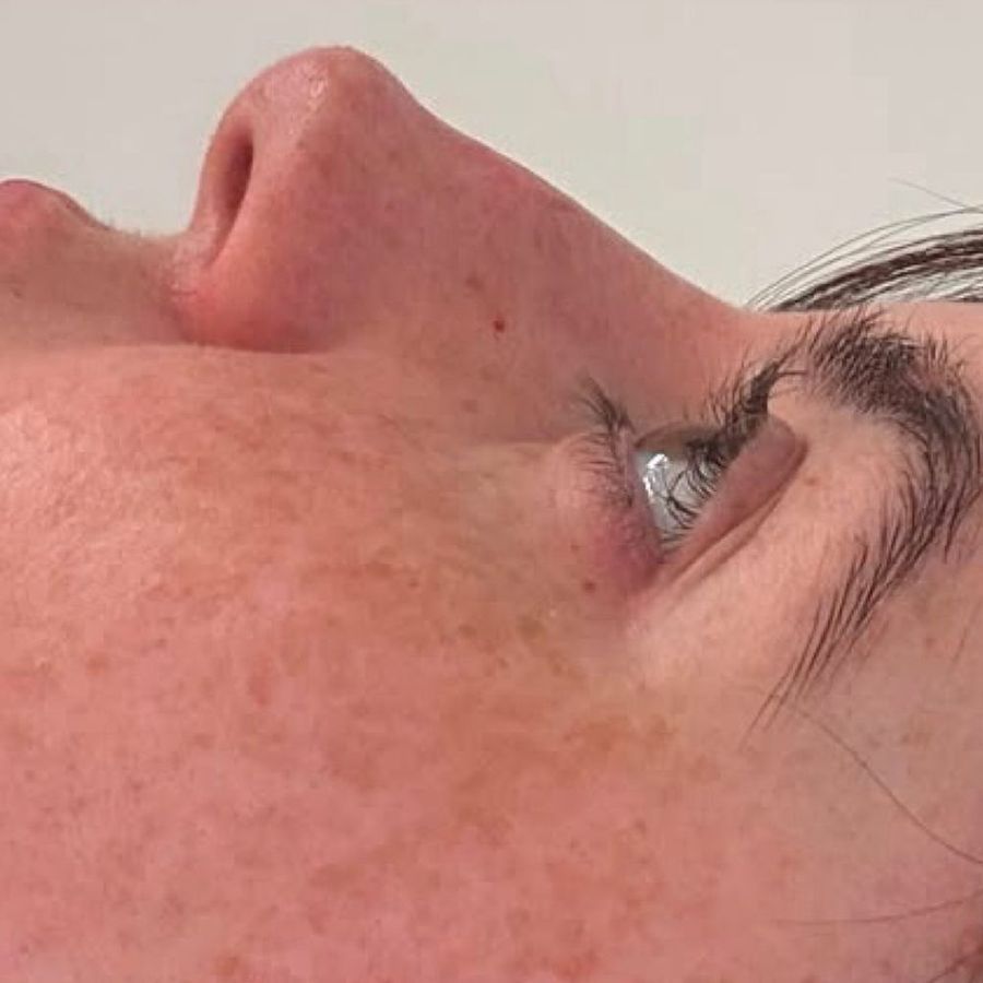 Non-surgical rhinoplasty at The Face Lab, after treatment by Becci