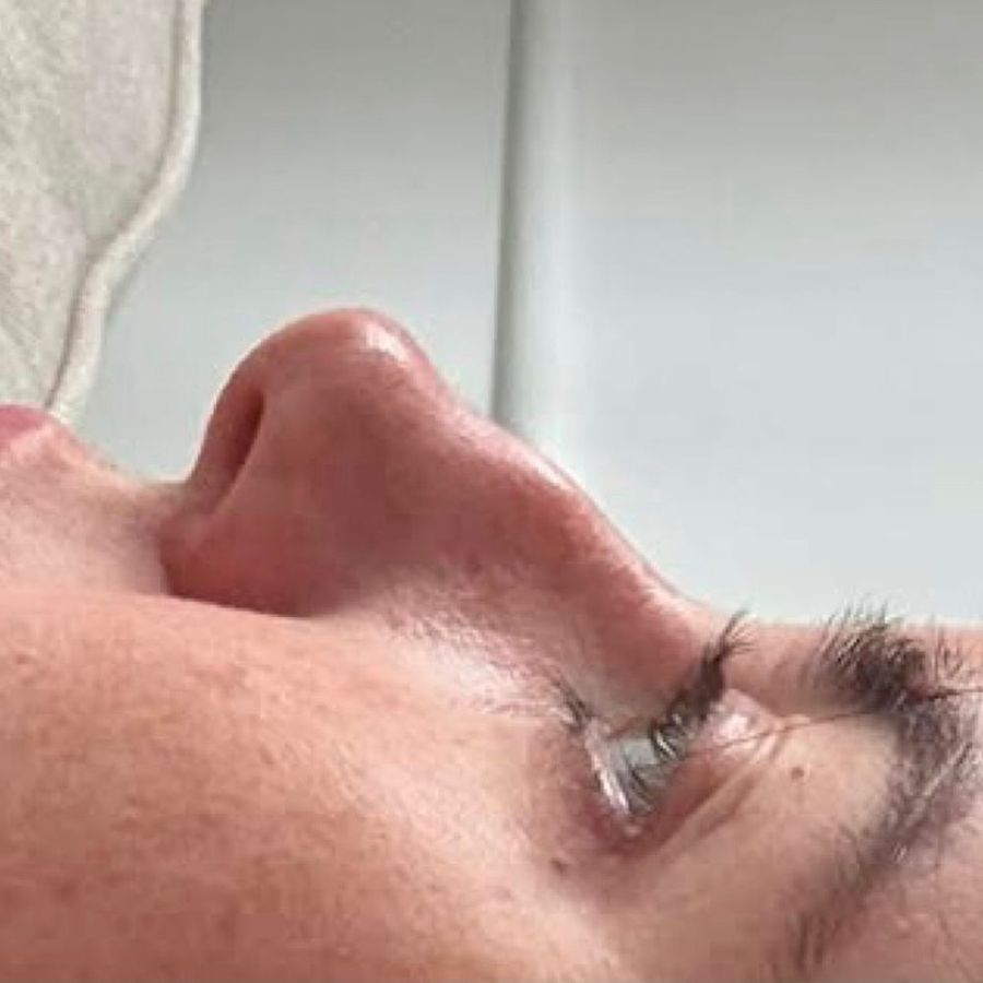 Non-surgical rhinoplasty at The Face Lab, before treatment